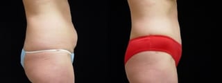 Before and after Tummy Tuck case 32645 - Angle 3