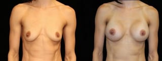 Before and after Breast Augmentation case 32646 - Angle 1