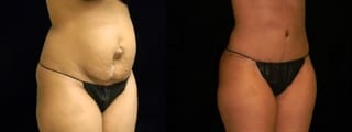 Before and after Tummy Tuck case 32648 - Angle 2
