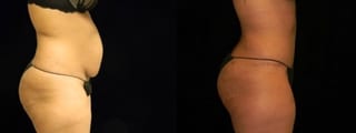 Before and after Tummy Tuck case 32648 - Angle 3