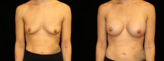 Before and after Breast Augmentation case 32649 - Angle 1
