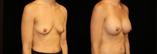 Before and after Breast Augmentation case 32649 - Angle 2