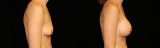 Before and after Breast Augmentation case 32649 - Angle 3