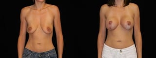 Before and after Breast Augmentation with Lift case 32650 - Angle 1