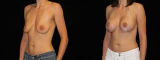 Before and after Breast Augmentation with Lift case 32650 - Angle 2