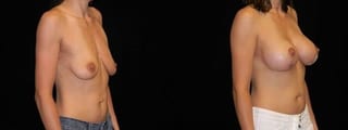 Before and after Breast Augmentation with Lift case 32650 - Angle 4