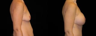 Before and after Mommy Makeover case 32651 - Angle 3