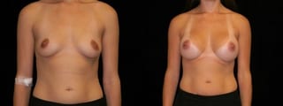 Before and after Breast Augmentation case 32652 - Angle 1