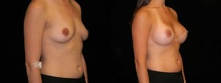 Before and after Breast Augmentation case 32652 - Angle 2
