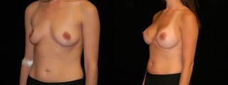 Before and after Breast Augmentation case 32652 - Angle 3