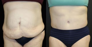 Before and after Tummy Tuck case 32653 - Angle 1