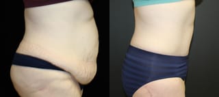 Before and after Tummy Tuck case 32653 - Angle 3