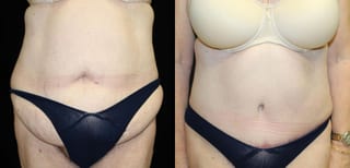 Before and after Tummy Tuck case 32654 - Angle 1