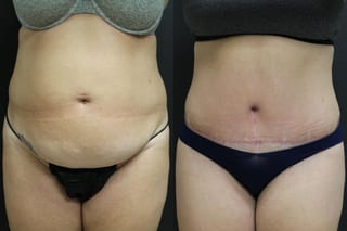 Before and after Tummy Tuck case 32655 - Angle 1