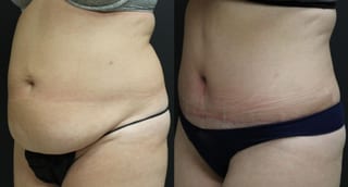 Before and after Tummy Tuck case 32655 - Angle 2