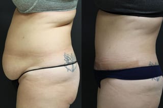 Before and after Tummy Tuck case 32655 - Angle 3