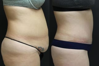 Before and after Tummy Tuck case 32655 - Angle 4