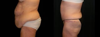 Before and after Tummy Tuck case 32656 - Angle 1
