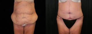 Before and after Tummy Tuck case 32656 - Angle 2