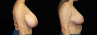 Before and after Breast Reduction case 32657 - Angle 2