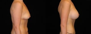 Before and after Mommy Makeover case 32658 - Angle 2