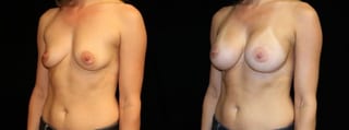 Before and after Breast Augmentation case 32659 - Angle 2
