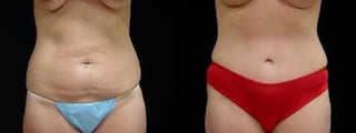 Before and after Mommy Makeover case 32660 - Angle 1