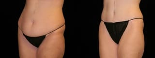 Before and after Mommy Makeover case 32662 - Angle 2