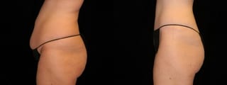 Before and after Mommy Makeover case 32662 - Angle 3