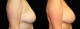 Before and after Breast Augmentation case 32663 - Angle 3
