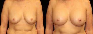 Before and after Breast Augmentation case 32664 - Angle 1