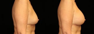 Before and after Breast Augmentation case 32664 - Angle 3