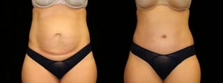 Before and after Tummy Tuck case 32665 - Angle 1