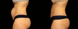 Before and after Tummy Tuck case 32665 - Angle 3
