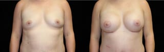 Before and after Breast Augmentation case 32666 - Angle 1