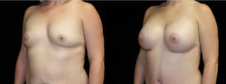 Before and after Breast Augmentation case 32666 - Angle 2