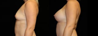 Before and after Breast Augmentation case 32666 - Angle 3