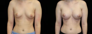 Before and after Breast Augmentation case 32669 - Angle 1
