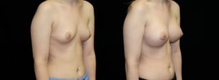 Before and after Breast Augmentation case 32669 - Angle 2