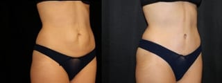 Before and after Tummy Tuck case 32668 - Angle 2