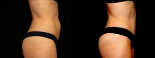 Before and after Tummy Tuck case 32668 - Angle 3