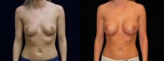 Before and after Breast Augmentation case 32670 - Angle 1