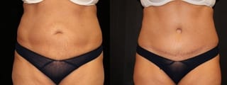 Before and after Tummy Tuck case 32672 - Angle 1
