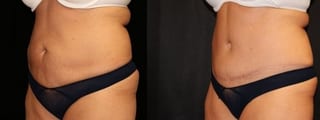 Before and after Tummy Tuck case 32672 - Angle 2