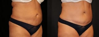 Before and after Tummy Tuck case 32672 - Angle 3