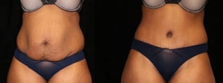 Before and after Tummy Tuck case 32673 - Angle 1