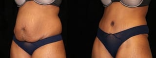 Before and after Tummy Tuck case 32673 - Angle 2