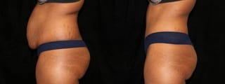 Before and after Tummy Tuck case 32673 - Angle 3