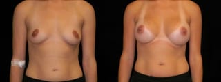 Before and after Breast Augmentation case 32674 - Angle 1