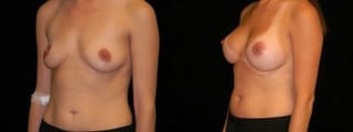 Before and after Breast Augmentation case 32674 - Angle 2
